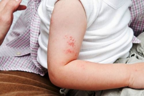 Você sabe o que é Herpes Zoster?