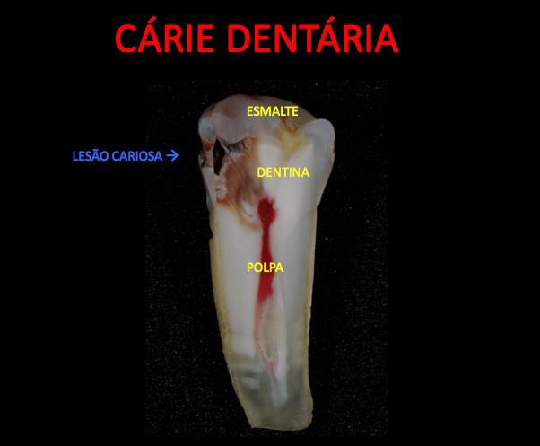 rais-data-saude-Cárie2