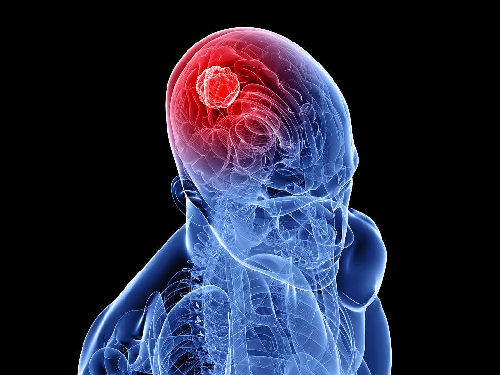 Estudos afirmam: Zika pode eliminar tumor humano avançado!