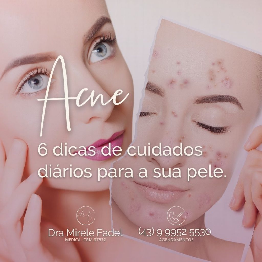 Acne: 6 dicas de cuidados diários para sua pele