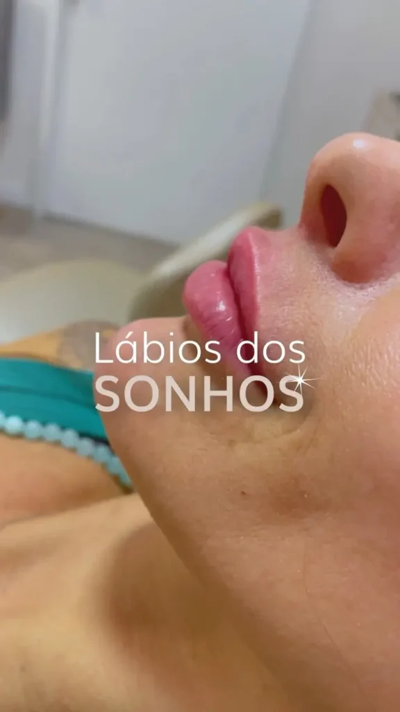 Lábios perfeitos com preenchimento de ácido hialurônico! Melhore projeção, hidratação e volume. Saiba mais.