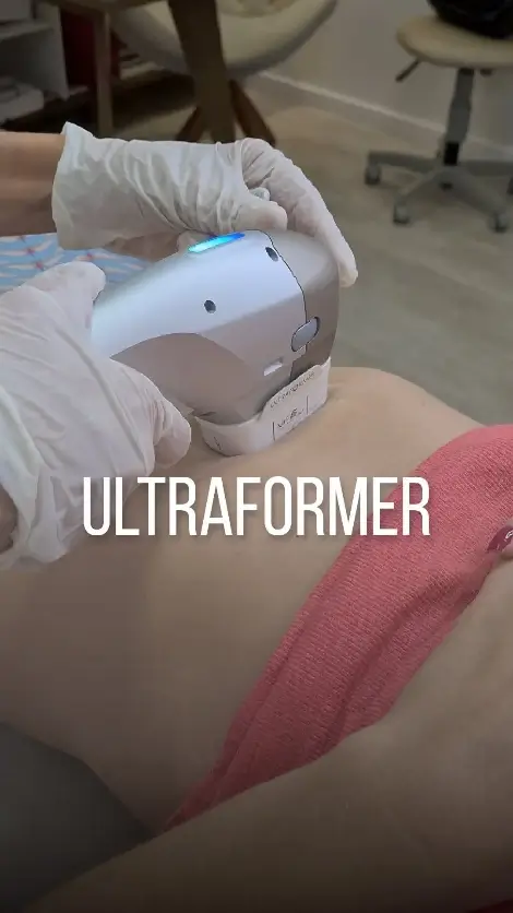 Ultraformer MPT Rejuvenescimento flacidez celulites não invasivo seguro Dra Mirele Fadel Beauty Discovery Clinic